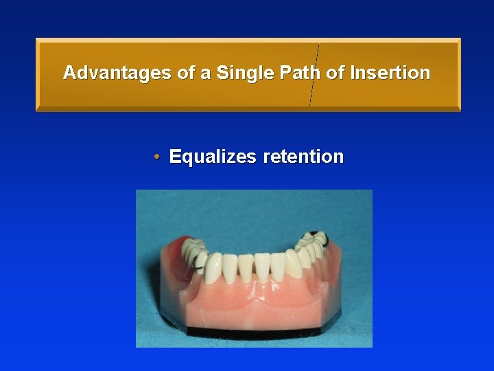 Advantages of a Single Path of Insertion • Equalizes retention 