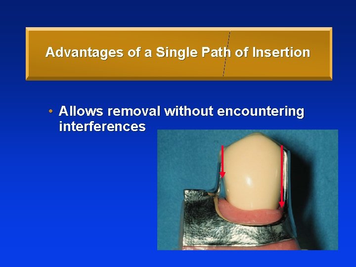 Advantages of a Single Path of Insertion • Allows removal without encountering interferences 