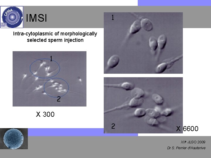 IMSI 1 Intra-cytoplasmic of morphologically selected sperm injection 1 2 X 300 2 X