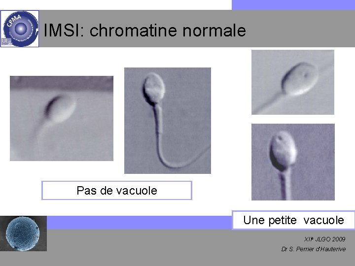 IMSI: chromatine normale Pas de vacuole Une petite vacuole XIIe JLGO 2009 Dr S.