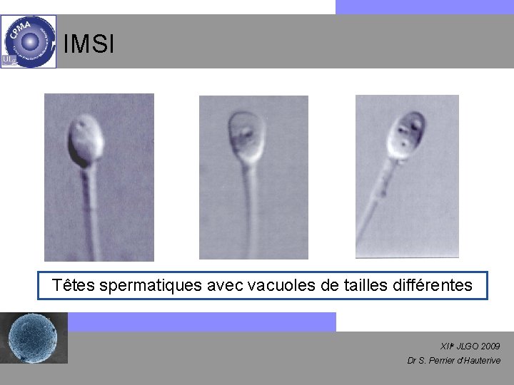 IMSI Têtes spermatiques avec vacuoles de tailles différentes XIIe JLGO 2009 Dr S. Perrier