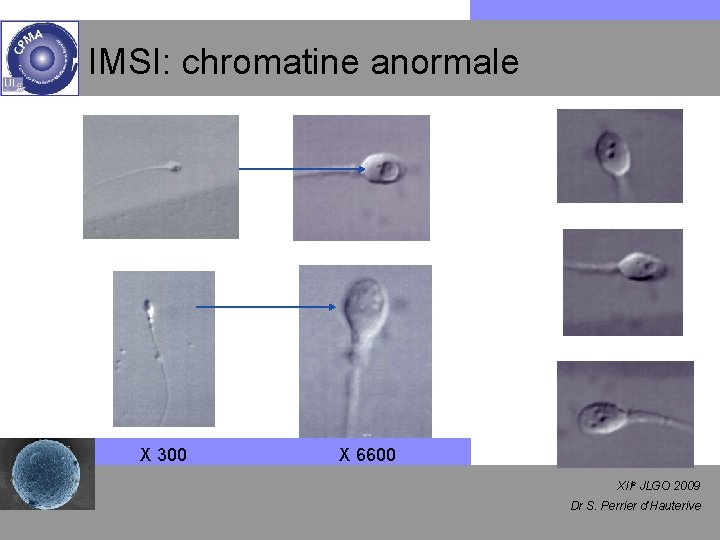 IMSI: chromatine anormale X 300 X 6600 XIIe JLGO 2009 Dr S. Perrier d’Hauterive