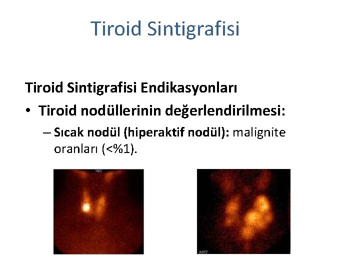 Tiroid Sintigrafisi Endikasyonları • Tiroid nodüllerinin değerlendirilmesi: – Sıcak nodül (hiperaktif nodül): malignite oranları