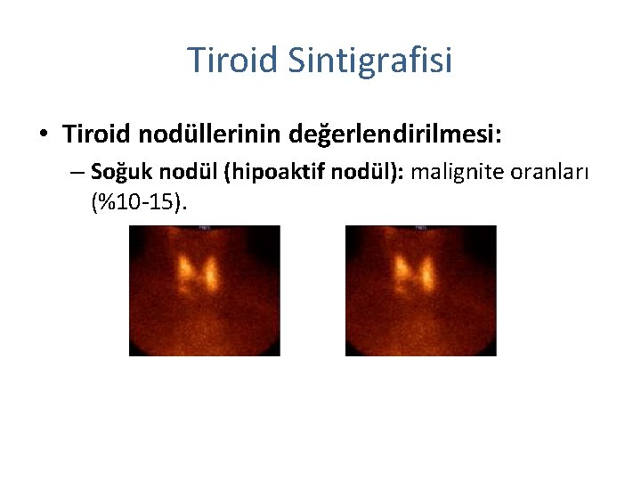 Tiroid Sintigrafisi • Tiroid nodüllerinin değerlendirilmesi: – Soğuk nodül (hipoaktif nodül): malignite oranları (%10