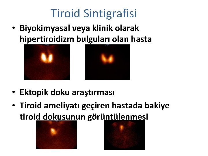 Tiroid Sintigrafisi • Biyokimyasal veya klinik olarak hipertiroidizm bulguları olan hasta • Ektopik doku