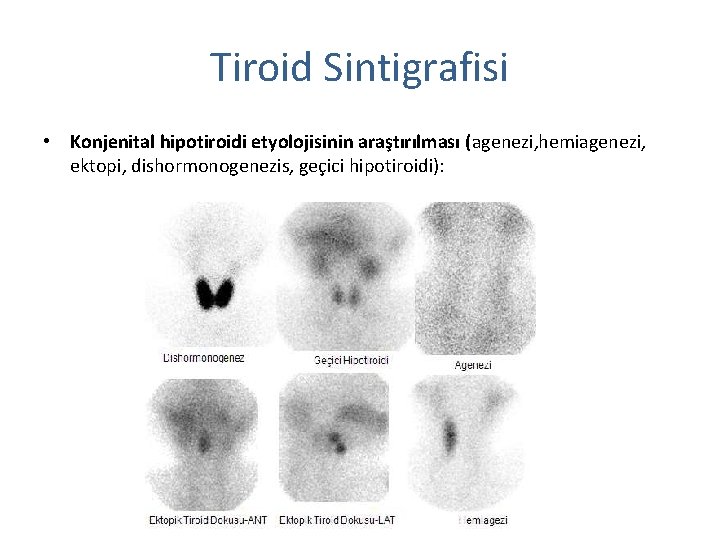 Tiroid Sintigrafisi • Konjenital hipotiroidi etyolojisinin araştırılması (agenezi, hemiagenezi, ektopi, dishormonogenezis, geçici hipotiroidi): 