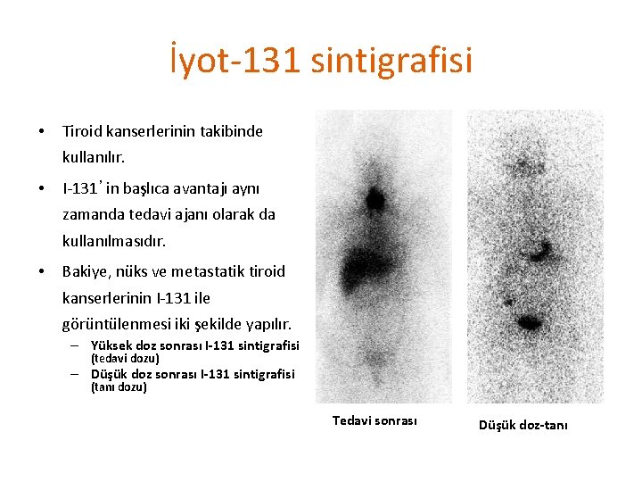 İyot-131 sintigrafisi • Tiroid kanserlerinin takibinde kullanılır. • I-131’in başlıca avantajı aynı zamanda tedavi