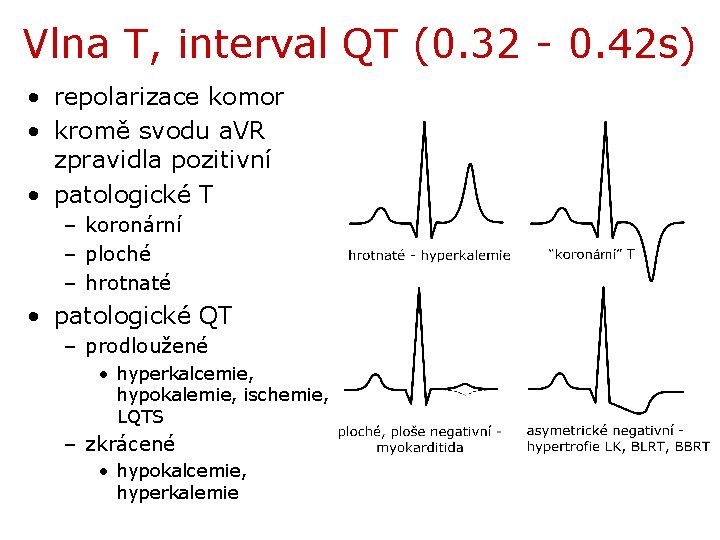 Vlna T, interval QT (0. 32 - 0. 42 s) • repolarizace komor •