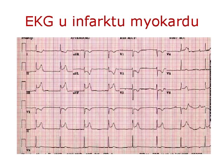 EKG u infarktu myokardu 