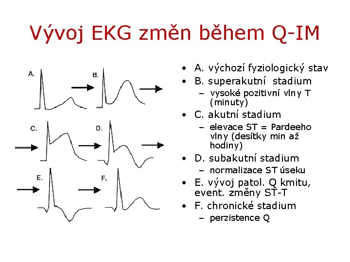 Vývoj EKG změn během Q-IM • A. výchozí fyziologický stav • B. superakutní stadium
