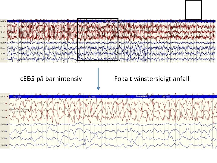 c. EEG på barnintensiv Fokalt vänstersidigt anfall c. EEG på barnintensiv Fokalt vänstersidigt anfall