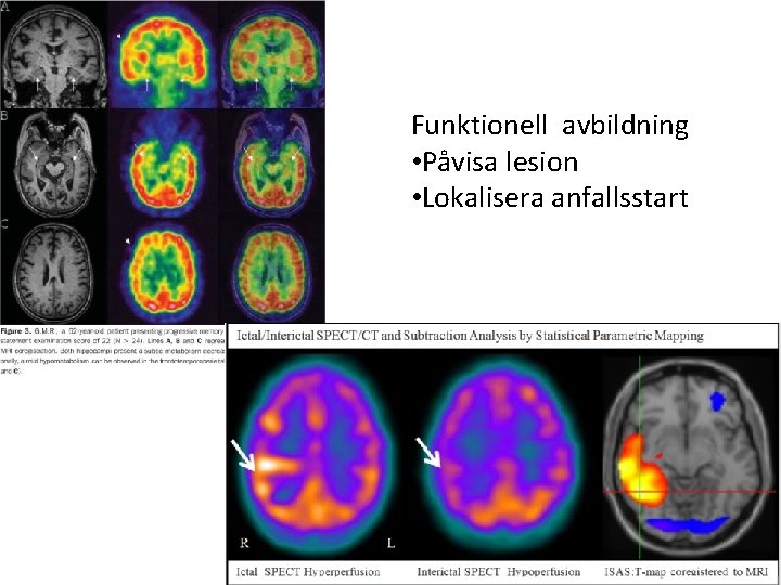 Funktionell avbildning • Påvisa lesion • Lokalisera anfallsstart Tommy Stödberg 36 Funktionell avbildning • Påvisa lesion • Lokalisera anfallsstart Tommy Stödberg 36