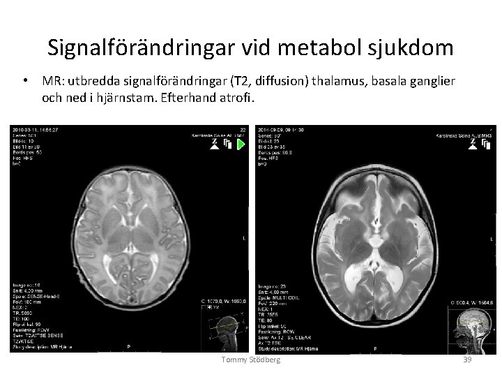 Signalförändringar vid metabol sjukdom • MR: utbredda signalförändringar (T 2, diffusion) thalamus, basala ganglier Signalförändringar vid metabol sjukdom • MR: utbredda signalförändringar (T 2, diffusion) thalamus, basala ganglier