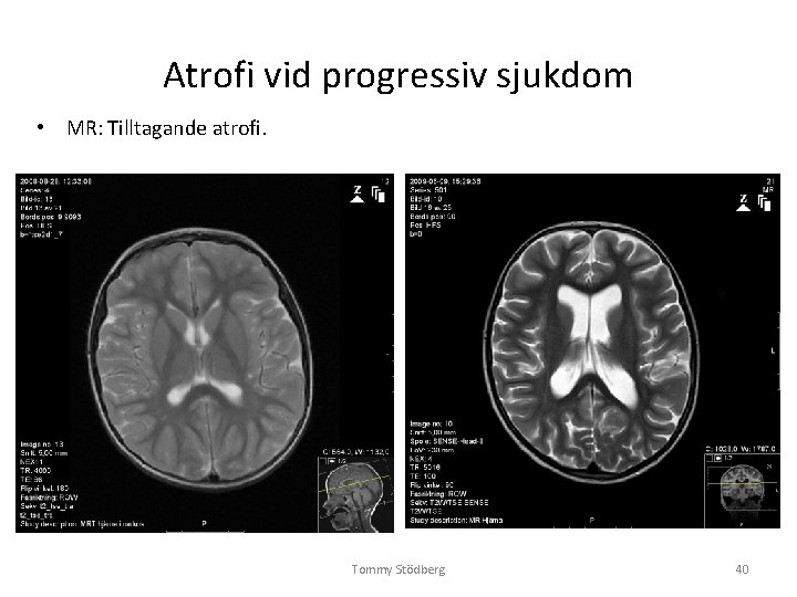 Atrofi vid progressiv sjukdom • MR: Tilltagande atrofi. Tommy Stödberg 40 Atrofi vid progressiv sjukdom • MR: Tilltagande atrofi. Tommy Stödberg 40