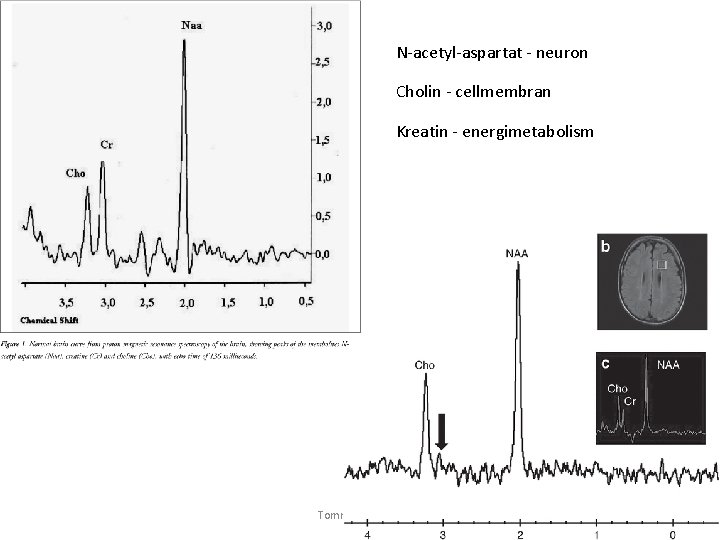 N-acetyl-aspartat - neuron Cholin - cellmembran Kreatin - energimetabolism Tommy Stödberg 41 N-acetyl-aspartat - neuron Cholin - cellmembran Kreatin - energimetabolism Tommy Stödberg 41