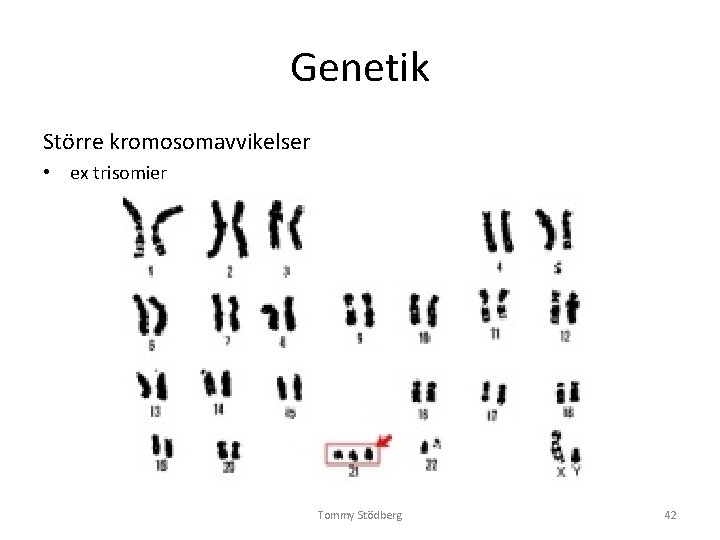 Genetik Större kromosomavvikelser • ex trisomier Tommy Stödberg 42 Genetik Större kromosomavvikelser • ex trisomier Tommy Stödberg 42