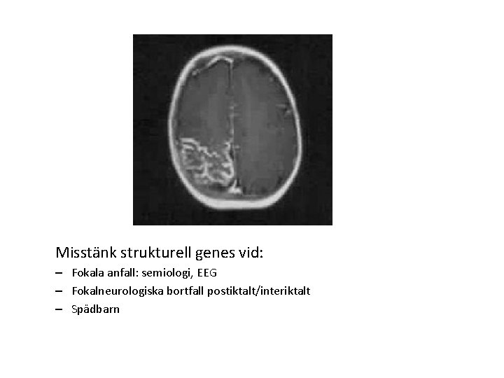 Misstänk strukturell genes vid: – Fokala anfall: semiologi, EEG – Fokalneurologiska bortfall postiktalt/interiktalt – Misstänk strukturell genes vid: – Fokala anfall: semiologi, EEG – Fokalneurologiska bortfall postiktalt/interiktalt –