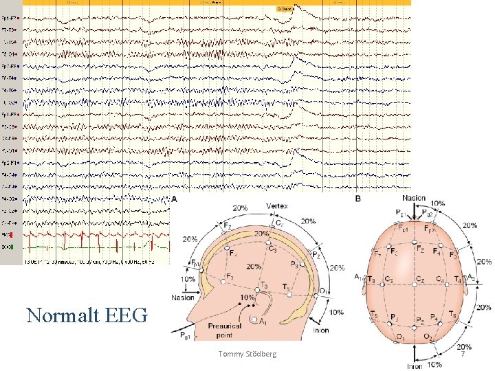 Normalt EEG Tommy Stödberg 7 Normalt EEG Tommy Stödberg 7