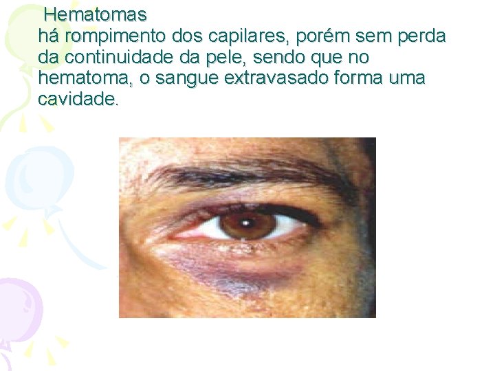 Hematomas há rompimento dos capilares, porém sem perda da continuidade da pele, sendo que