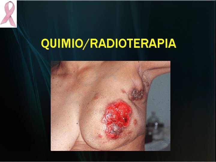 QUIMIO/RADIOTERAPIA QUIMIO/RADIOTERAPIA