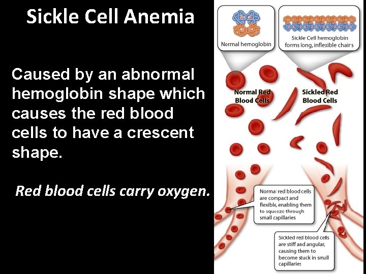 Sickle Cell Anemia Caused by an abnormal hemoglobin shape which causes the red blood