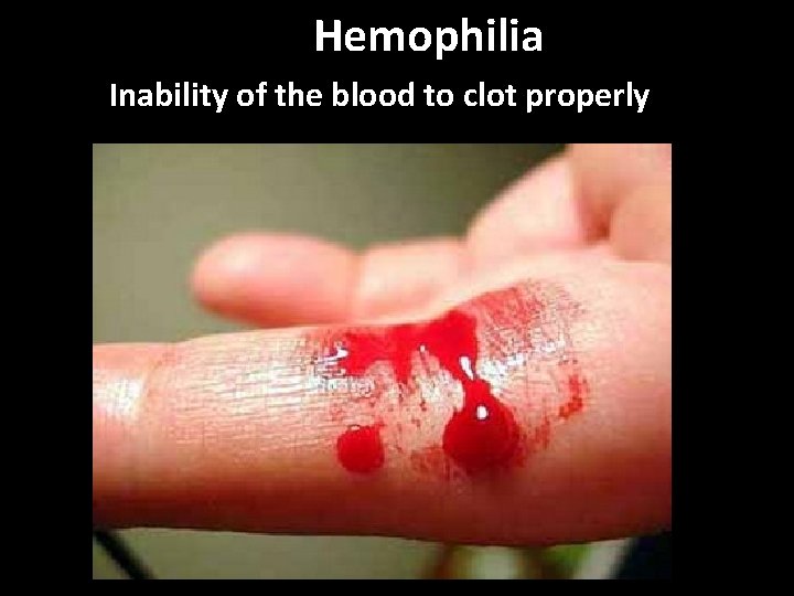 Hemophilia Inability of the blood to clot properly 