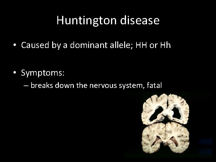 Huntington disease • Caused by a dominant allele; HH or Hh • Symptoms: –