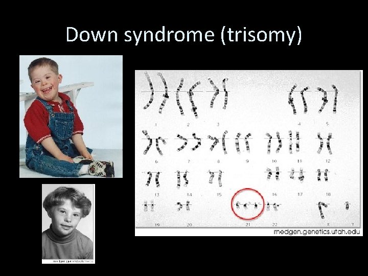 Down syndrome (trisomy) 