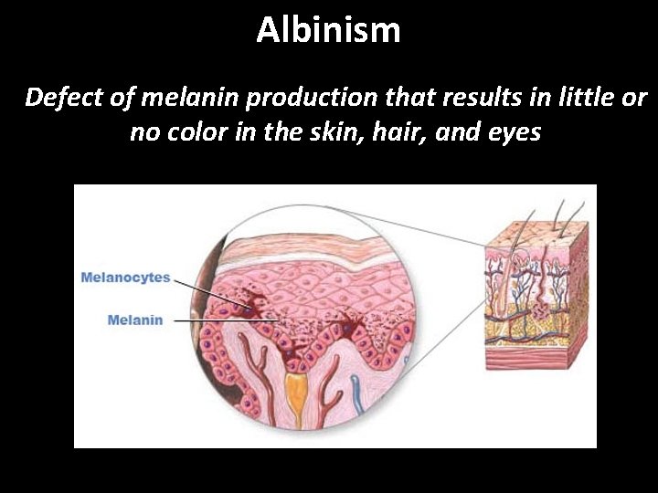 Albinism Defect of melanin production that results in little or no color in the