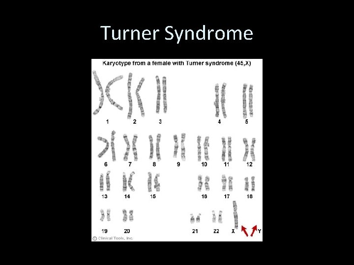 Turner Syndrome 