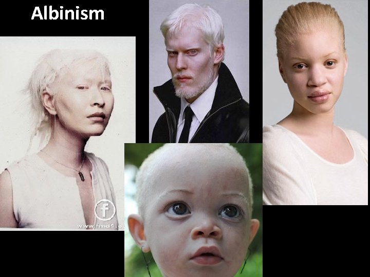 Albinism 