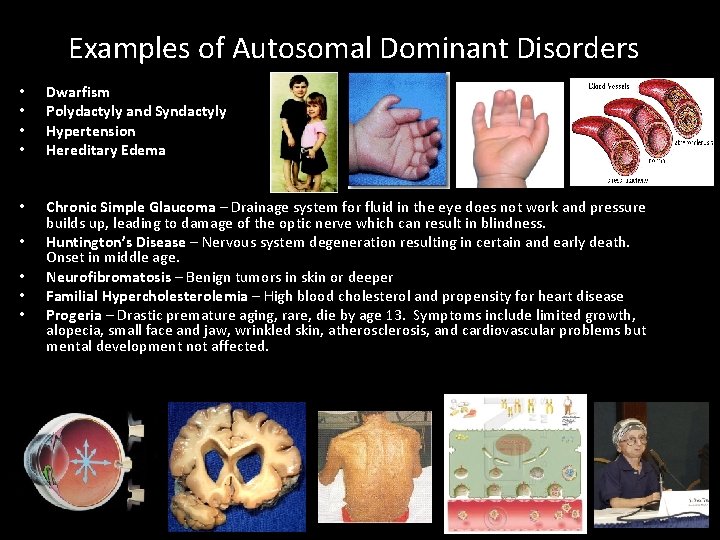 Examples of Autosomal Dominant Disorders • • Dwarfism Polydactyly and Syndactyly Hypertension Hereditary Edema