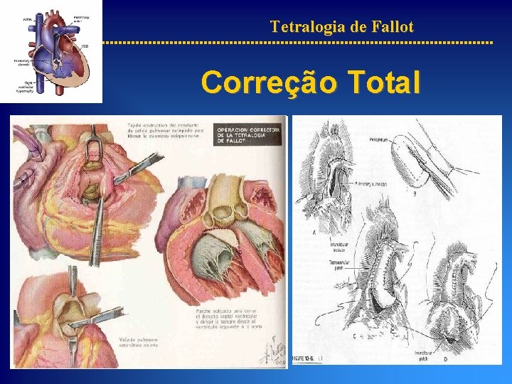 Tetralogia de Fallot Caso Clnico Apresentao Thomaz V