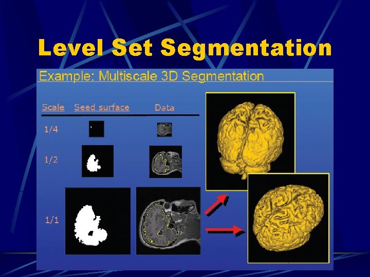 Level Set Segmentation 