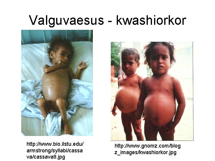 Valguvaesus - kwashiorkor http: //www. bio. ilstu. edu/ armstrong/syllabi/cassa va/cassava 8. jpg http: //www.