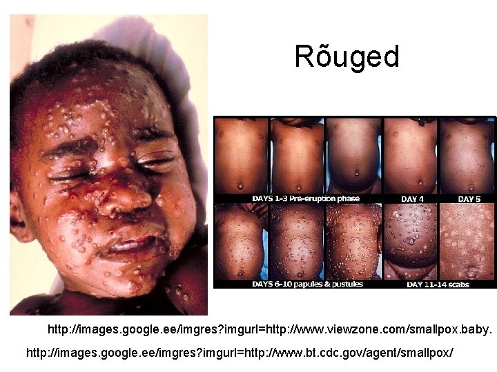 Rõuged http: //images. google. ee/imgres? imgurl=http: //www. viewzone. com/smallpox. baby. http: //images. google. ee/imgres?