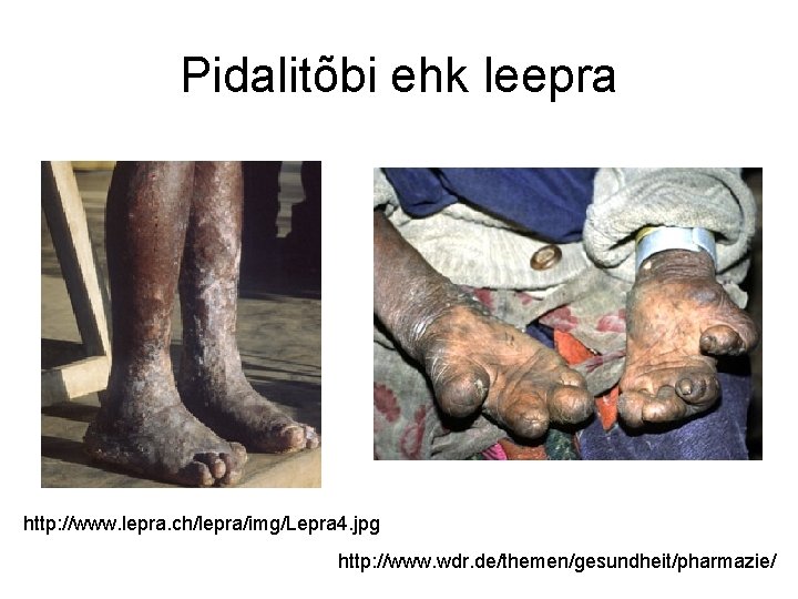 Pidalitõbi ehk leepra http: //www. lepra. ch/lepra/img/Lepra 4. jpg http: //www. wdr. de/themen/gesundheit/pharmazie/ 