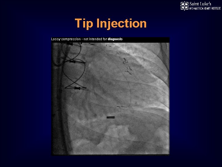 Tip Injection 
