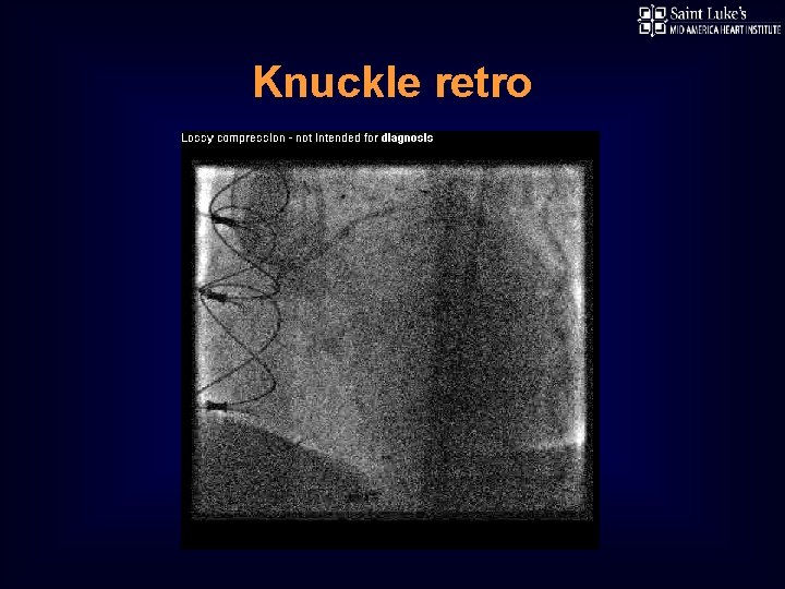 Knuckle retro 