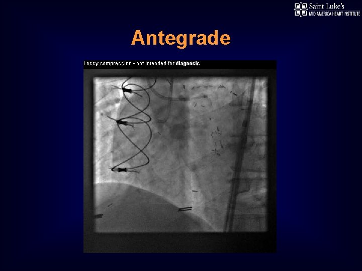 Antegrade 
