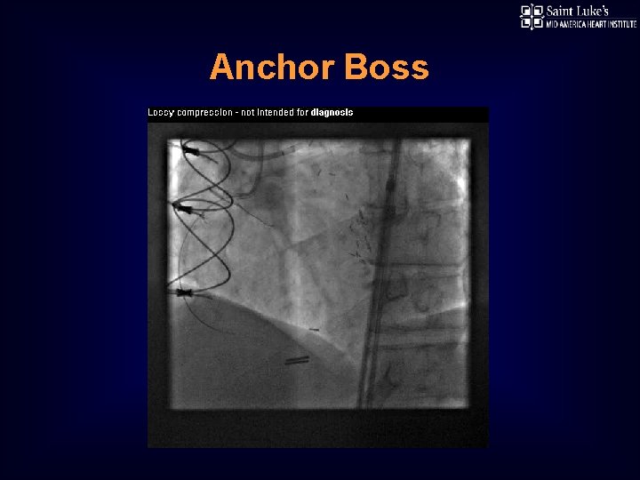 Anchor Boss 