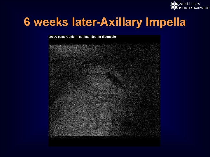 6 weeks later-Axillary Impella 