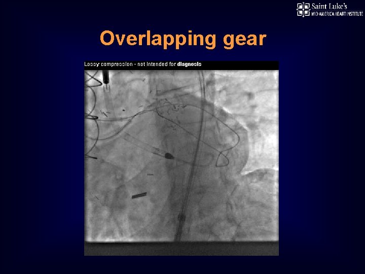 Overlapping gear 