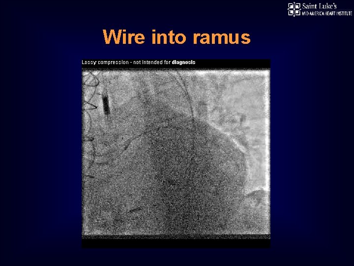 Wire into ramus 