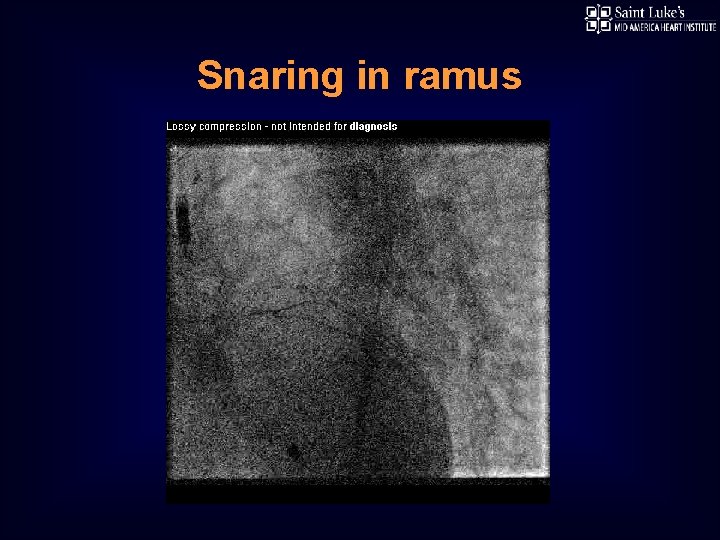 Snaring in ramus 
