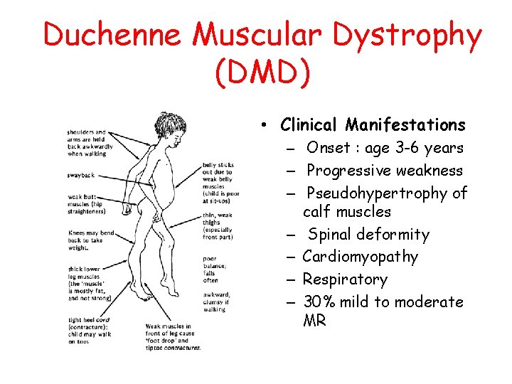 Duchenne Muscular Dystrophy (DMD) • Clinical Manifestations – Onset : age 3 -6 years