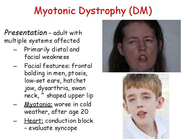 Myotonic Dystrophy (DM) Presentation – adult with multiple systems affected – Primarily distal and