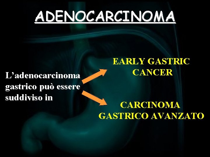 ADENOCARCINOMA L’adenocarcinoma gastrico può essere suddiviso in EARLY GASTRIC CANCER CARCINOMA GASTRICO AVANZATO 