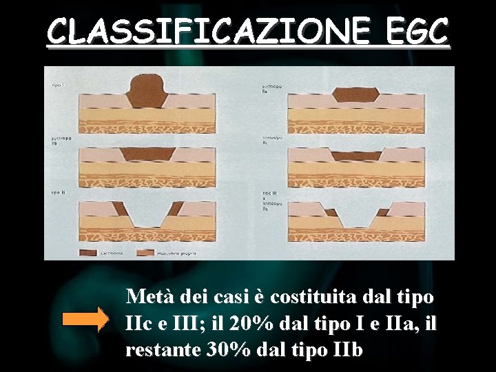 CLASSIFICAZIONE EGC Metà dei casi è costituita dal tipo IIc e III; il 20%