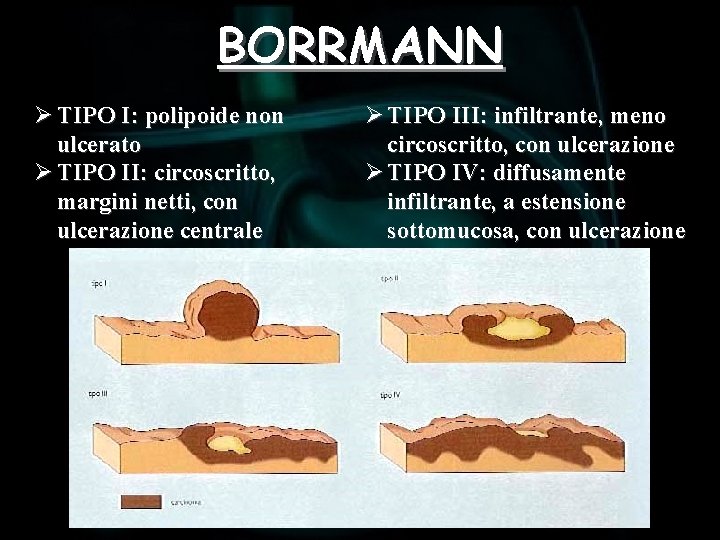 BORRMANN Ø TIPO I: polipoide non ulcerato Ø TIPO II: circoscritto, margini netti, con